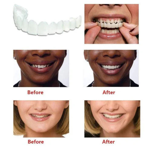UB™ Smile Fit Flex Teeth Denture